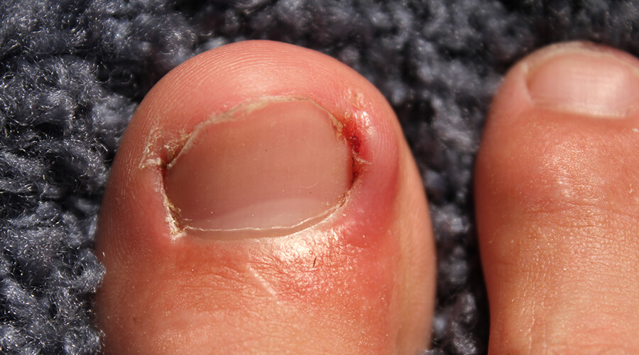 Ingrown Toenail