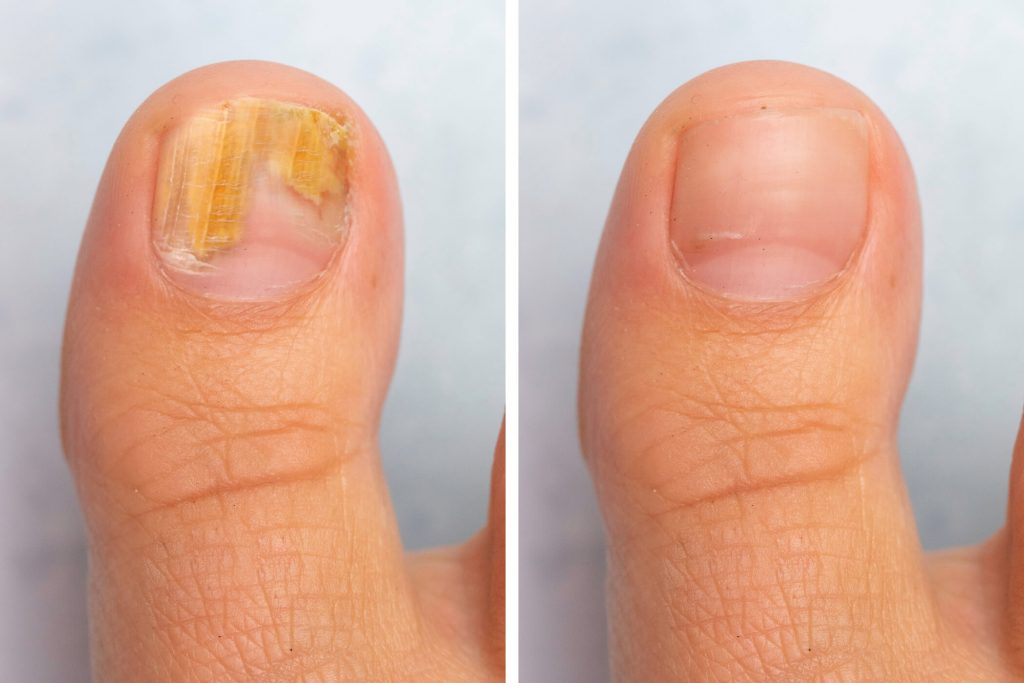 How To Stop Your Fungal Nail Infection Spreading Through Your Family |  Cartwright Podiatry