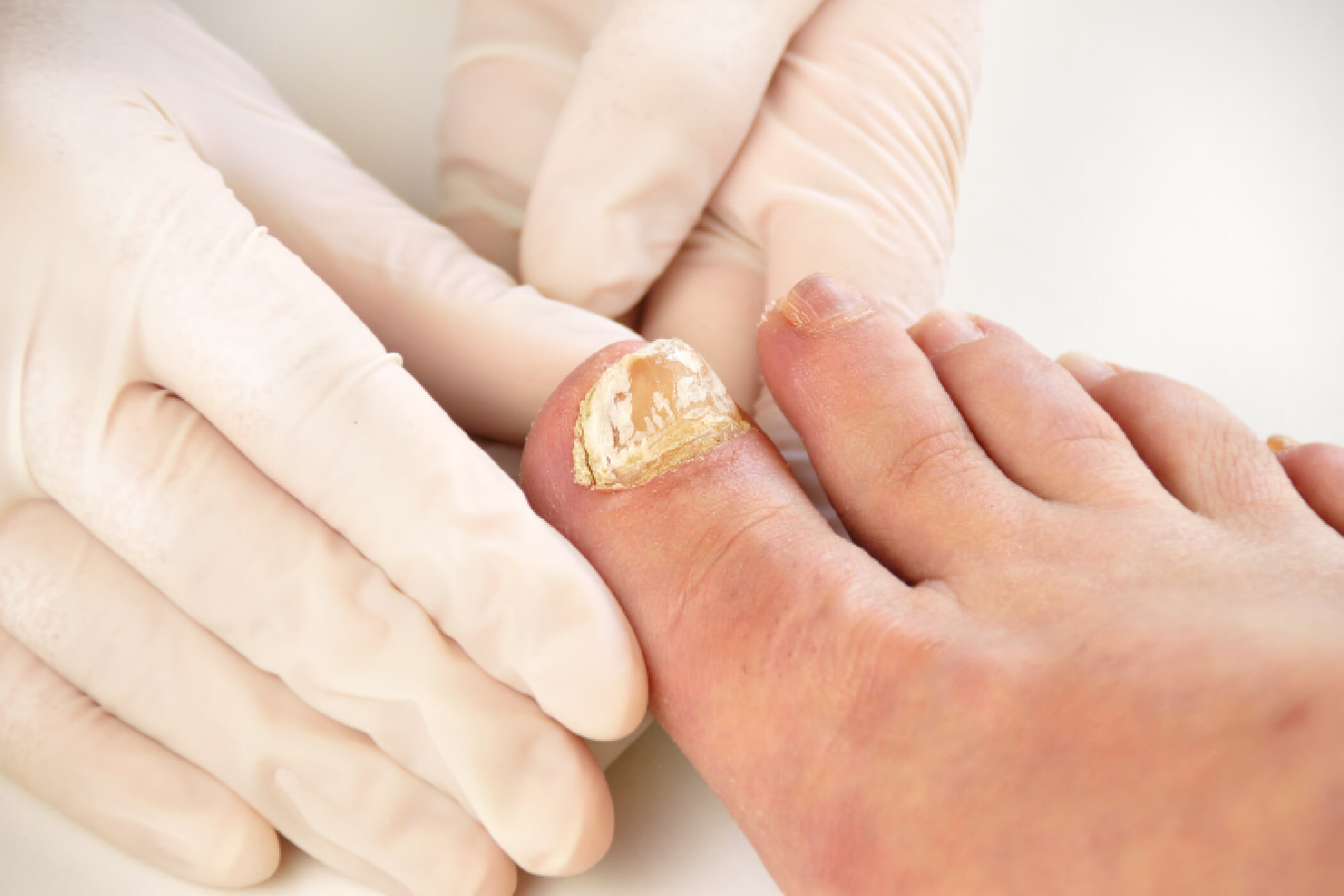 Excilor treatment of fungal nail infection